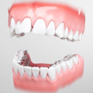 Brackets in the mouth2