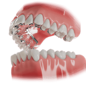 Brava braces hidden upper visible